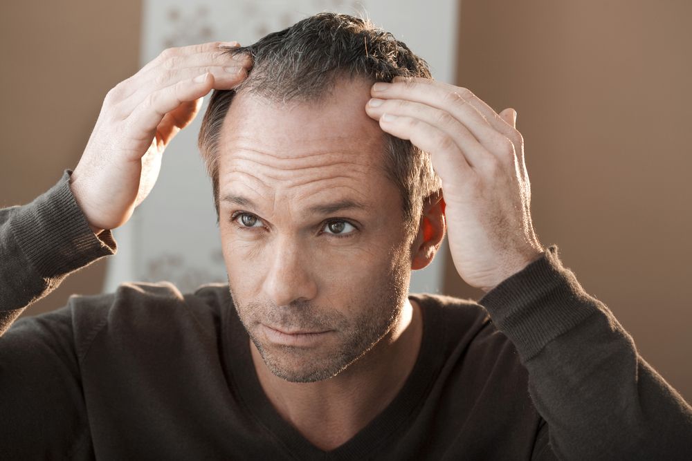 La alopecia masculina: tratamientos sí funcionan
